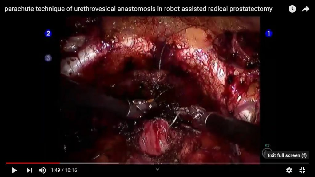 Parachute technique of Urethrovesical Anastomosis in robot assisted radical prostatectomy