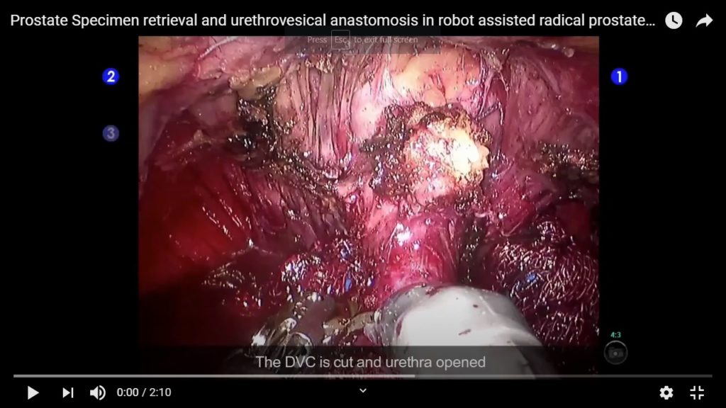 Prostate Specimen retrieval and urethrovesical anastomosis in robot assisted radical prostatectomy