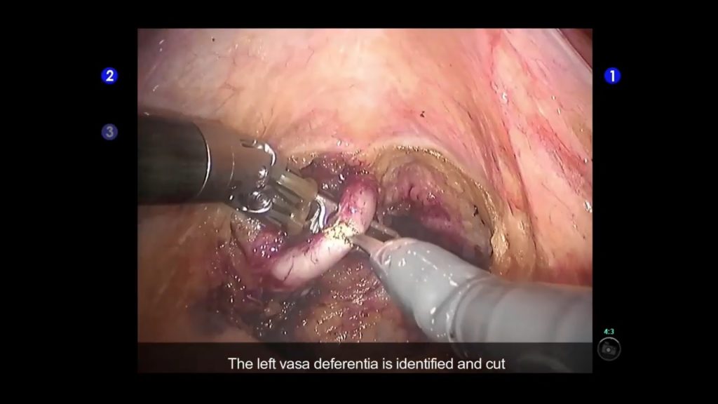 Initial dissection in robot assisted radical Prostatectomy
